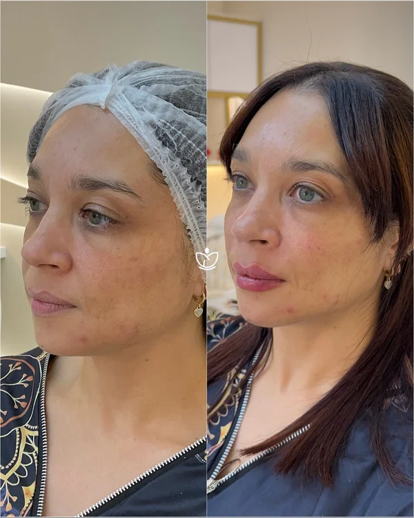 Antes e depois de harmonização facial, contorno e pele