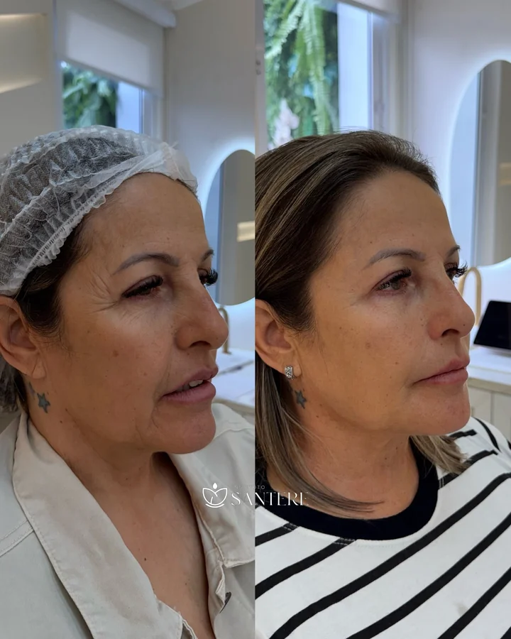 Antes e depois de harmonização facial em paciente madura