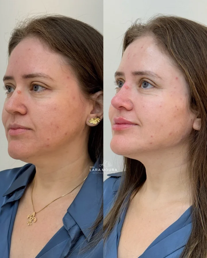 Antes e depois de harmonização facial, contorno