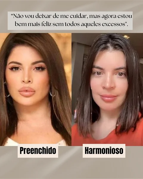 Comparação entre rosto preenchido em excesso e rosto harmonioso e natural